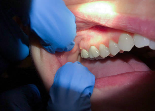 Best Emergency Tooth Extraction in Denison, IA